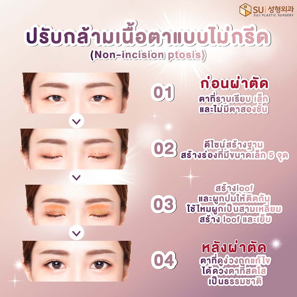 การปรับกล้ามเนื้อตา-ในผู้ที่ไม่มีตาสองชั้น