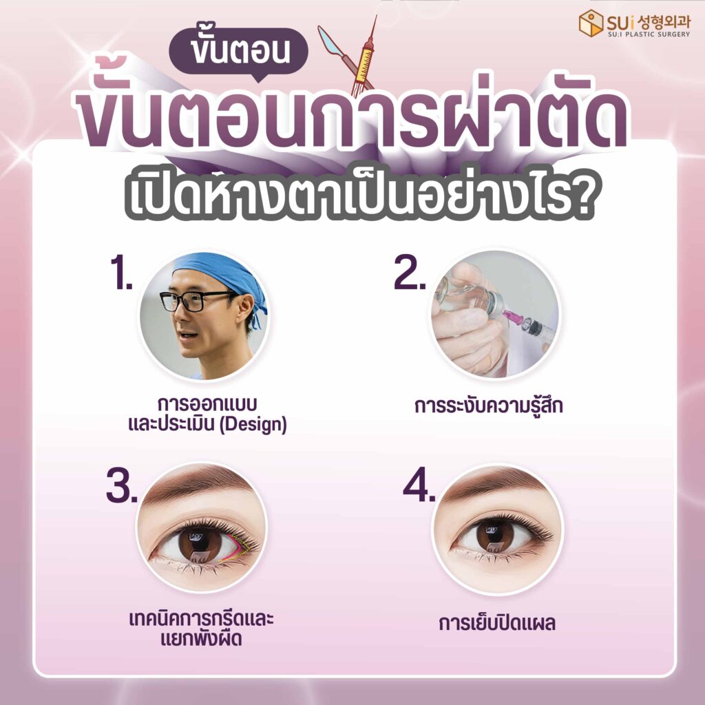ขั้นตอนการผ่าตัดเปิดหางตา