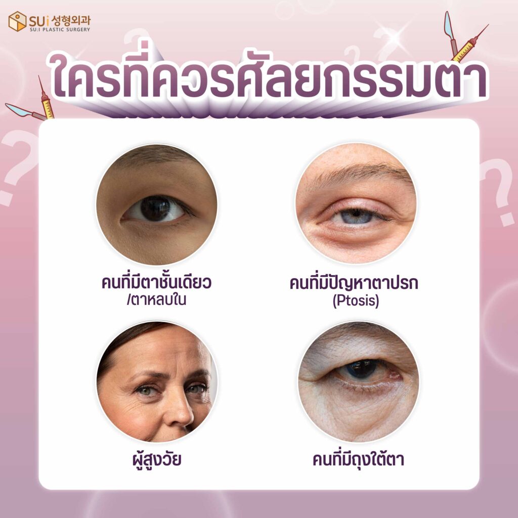 ศัลยกรรมตาเหมาะกับคนที่มีตาแบบไหน
