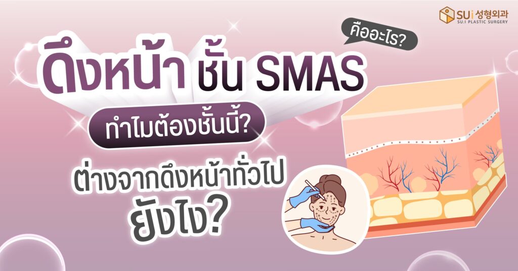 ดึงหน้าชั้น smas