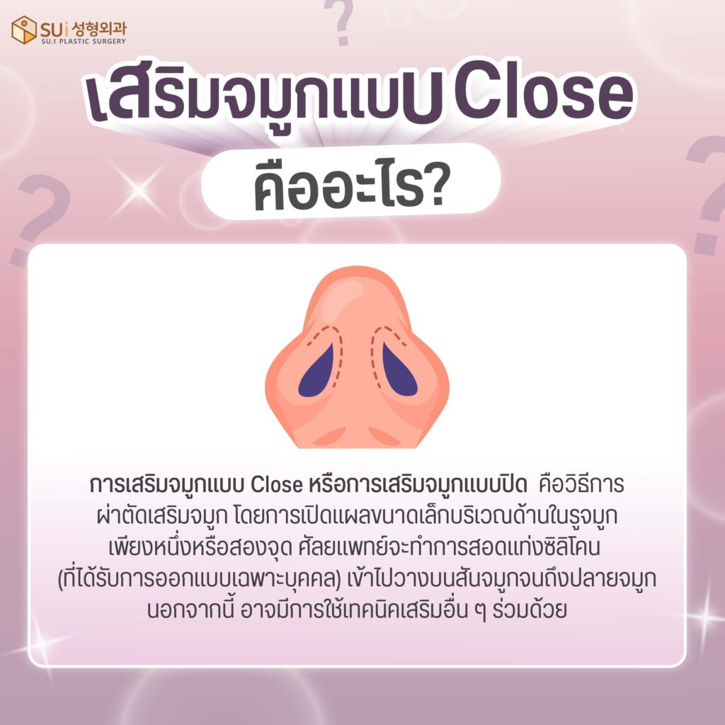 เสริมจมูกแบบ Close คือ