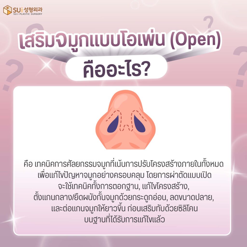 เสริมจมูกแบบโอเพ่น คือ