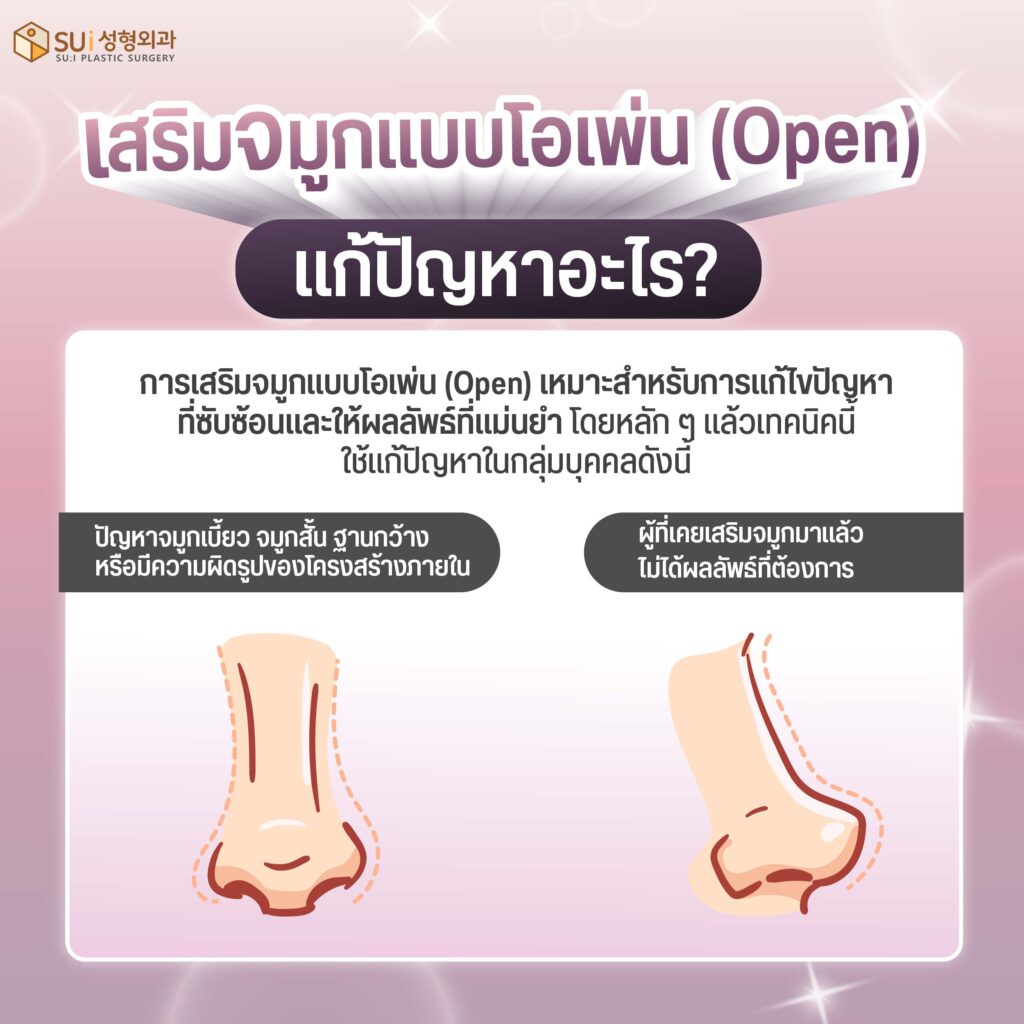เสริมจมูกแบบโอเพ่น ช่วยอะไรบ้าง