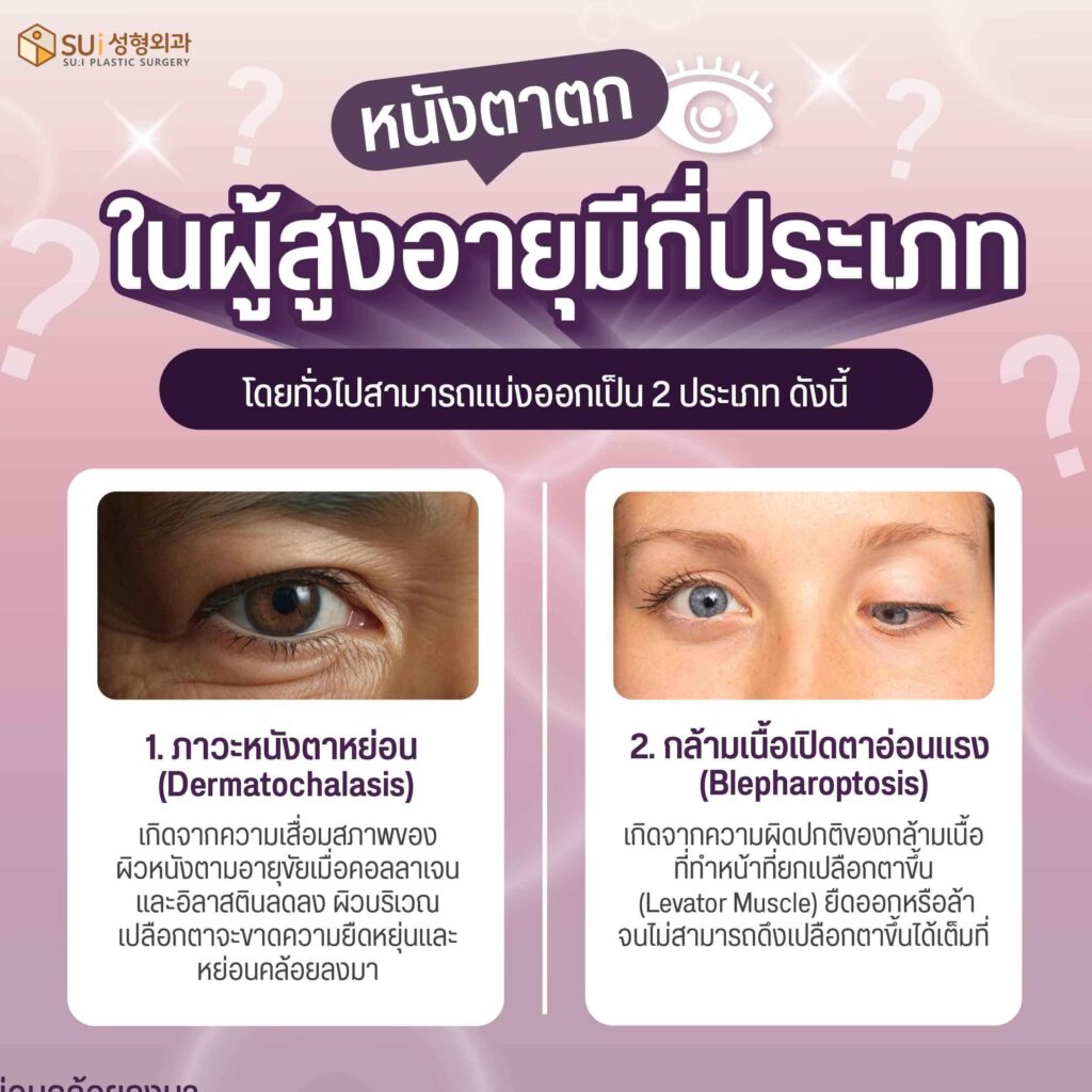 หนังตาตกในผู้สูงอายุมีกี่ประเภท