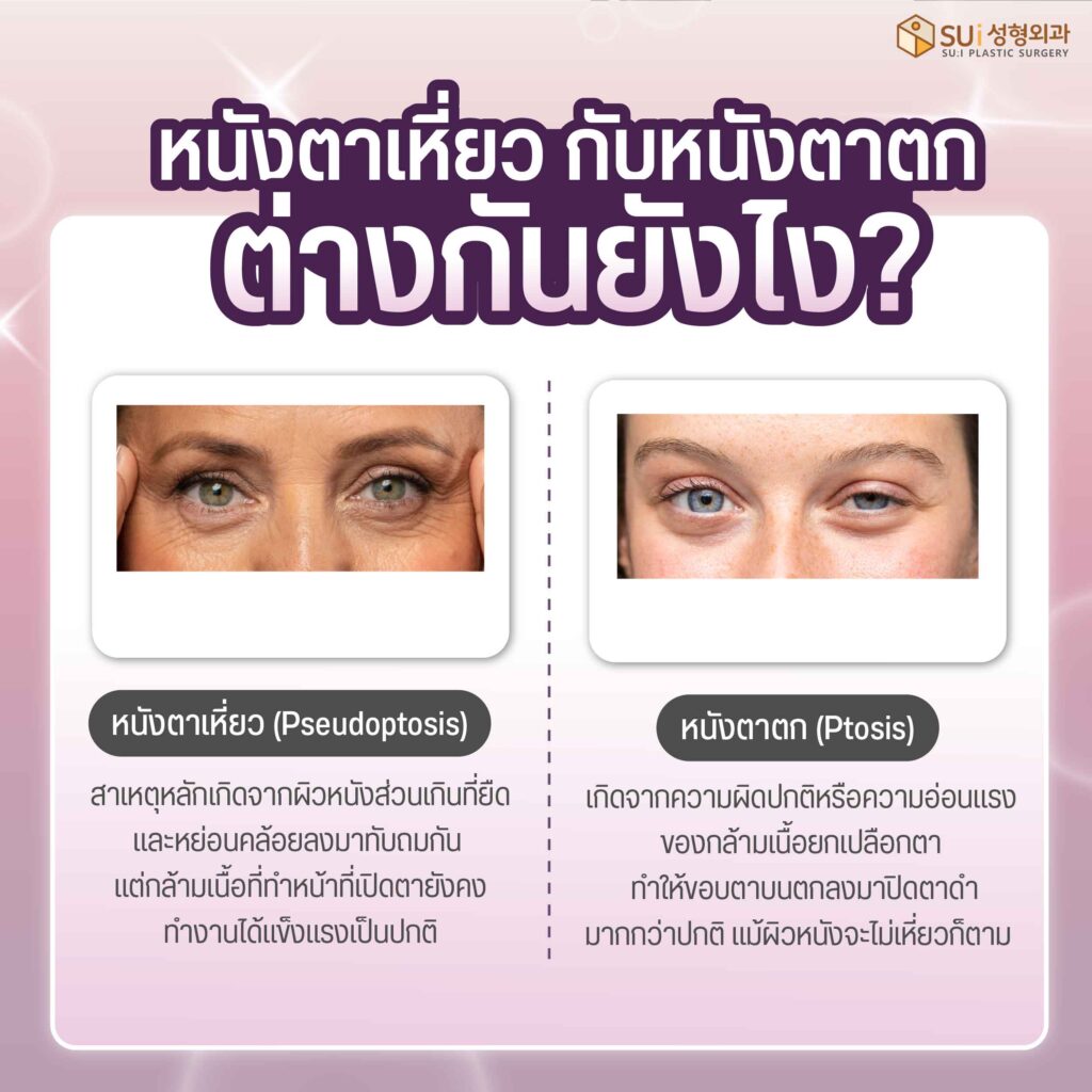 หนังตาเหี่ยว กับ หนังตาตก
