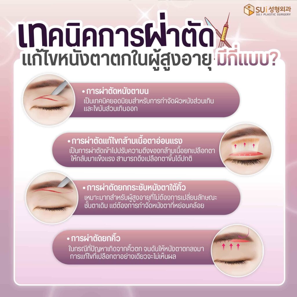 เทคนิคการผ่าตัดแก้ไขปัญหาหนังตาตกในผู้สูงอายุ