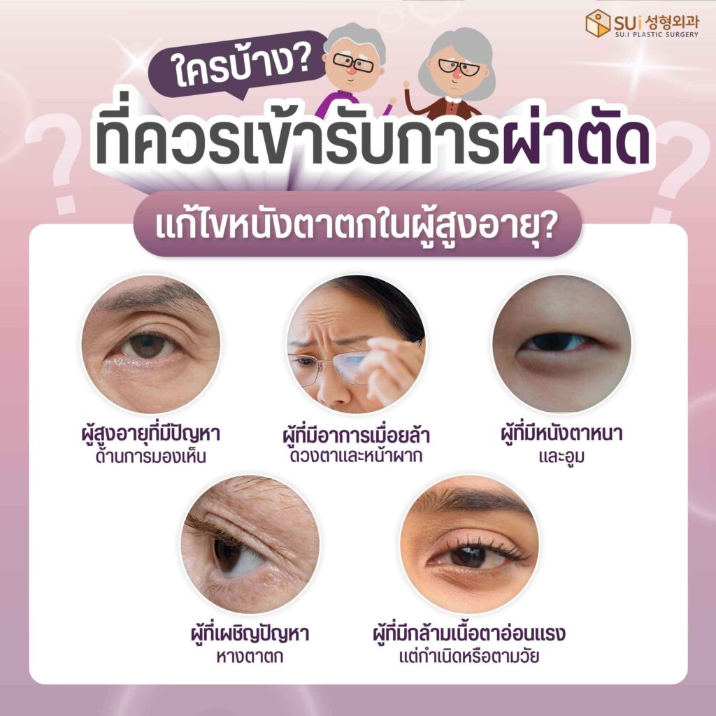 ใครบ้างที่ควรเข้ารับการผ่าตัดแก้ไขหนังตาตก